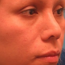 Lower Eyelid Skin Pinch by Dr. Henstrom