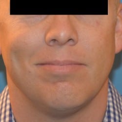 Chin Implant and Submental Liposuction by Dr. Thompson