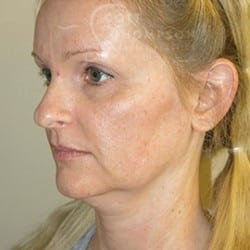 MACS Facelift Before & After Photos 816