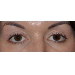 Upper Eyelid Surgery by Dr. Thompson