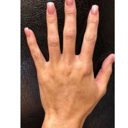 Hand Rejuvenation with Restylane Lyft