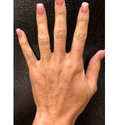 Hand Rejuvenation with Restylane Lyft