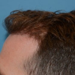 FUT Hair Transplant Before & After Pictures