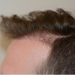 FUT Hair Transplant Before & After Pictures