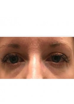 Tear Trough Rejuvenation with Restylane by Jeanna Wilkerson