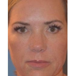 Botox and Juvederm
