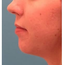 Chin Implant by Dr. Henstrom