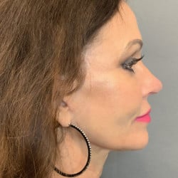 Macslift, Fat Injections, Upper Blepharoplasty, & Revision Rhinoplasty by Dr. Henstrom