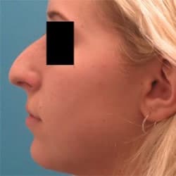 Rhinoplasty and Chin Implant  by Dr. Henstrom