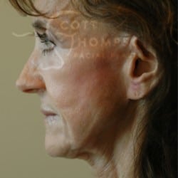 Facelift Before and After Photos | Utah Facial Plastics 303
