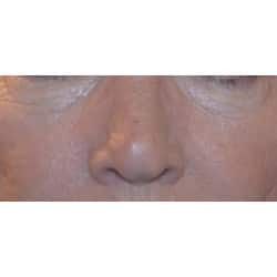 Lower Eyelid Surgery by Dr. Henstrom