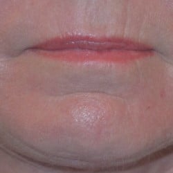 Peri-Oral Dermabrasion by Dr. Henstrom