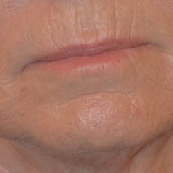 Peri-Oral Dermabrasion by Dr. Henstrom