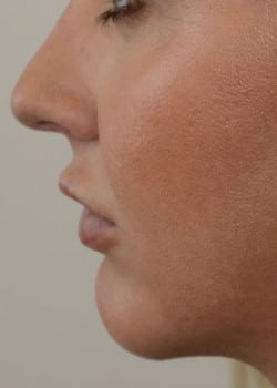 Chin Augmentation by Dr. Thompson