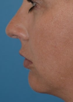 Chin Augmentation by Dr. Thompson
