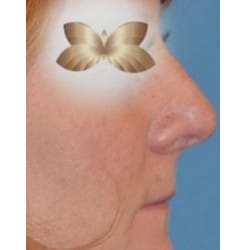 Non- Surgical Rhinoplasty by Dr. Henstrom