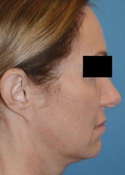 Macslift and Septorhinoplasty  by Dr. Thompson