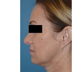 Macslift and Septorhinoplasty  by Dr. Thompson