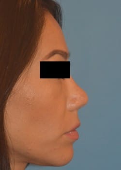 Revision Rhinoplasty by Dr. Thompson
