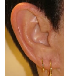 Earlobe Reduction by Dr. Thompson