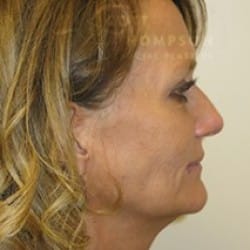 Facelift Before and After Photos | Utah Facial Plastics 751