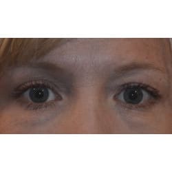 Upper and Lower Eyelid Surgery by Dr. Henstrom