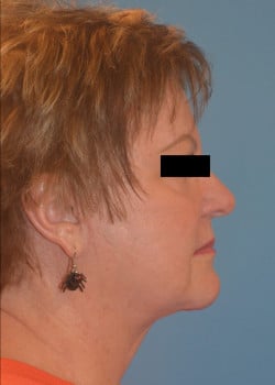 Facelift  by Dr.Thompson