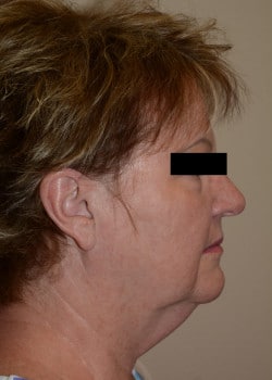 Facelift  by Dr.Thompson