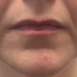 Lip Filler