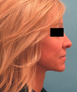 Macslift with Fat Injections by Dr. Henstrom