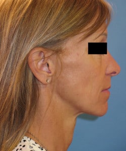 Macslift with Fat Injections by Dr. Henstrom