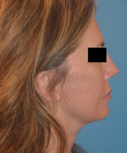 Facelift & Fat Injections by Dr. Thompson