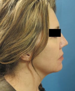 Facelift & Fat Injections by Dr. Thompson