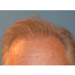 After Image: Hair Transplant by Dr. Thompson - front