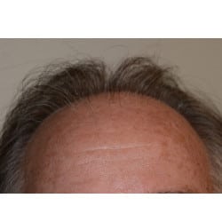 Before Image: Hair Transplant by Dr. Thompson - front