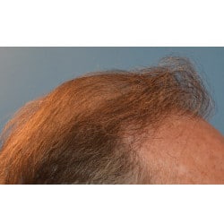 After Image: Hair Transplant by Dr. Thompson - other