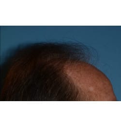 Before Image: Hair Transplant by Dr. Thompson - other
