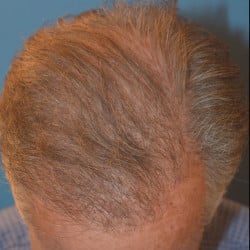 Hair Transplant by Dr. Thompson