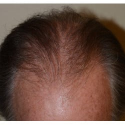 Before Image: Hair Transplant by Dr. Thompson - other