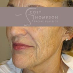 Facelift | Fat Injections | Upper Eyelid Surgery | Lower Eyelid Surgery with Fat Repositioning | Perioral Dermabrasion – 901