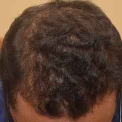 Hair Loss Treatment Hair Injections