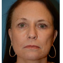 Browlift, Facelift  and Fat Injections