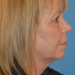 Macslift with Dermabrasion by Dr. Thompson