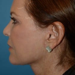 Facelift | Fat Injections – 784