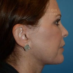 Facelift | Fat Injections – 784