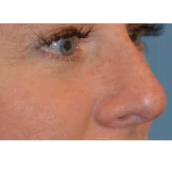 Non-Surgical Rhinoplasty by Dr. Henstrom