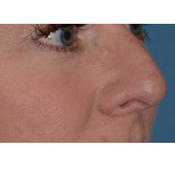 Non-Surgical Rhinoplasty by Dr. Henstrom