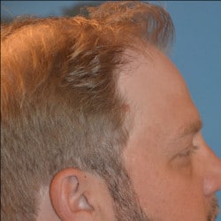 Hair Loss Treatment with ACell