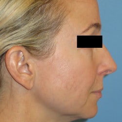 Fat Transfer and Laser Resurfacing by Dr. Thompson