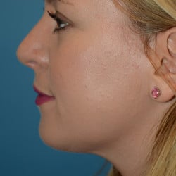 Rhinoplasty and Submental Lipo by Dr. Thompson